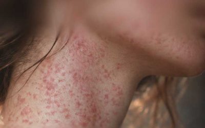 Health department: Somerset County has 14 cases of measles